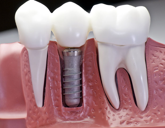Dental Implants: Why You Need Them