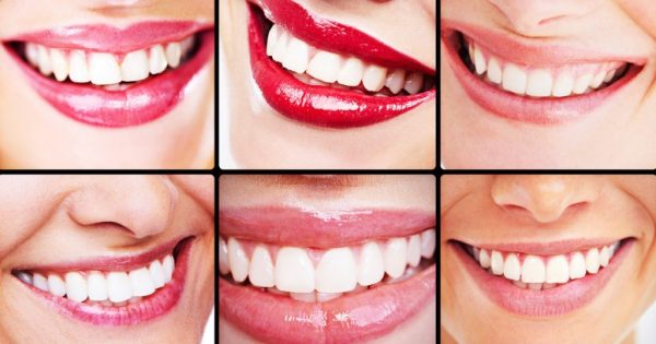 The differences between Veneers and Dental Bonding ...