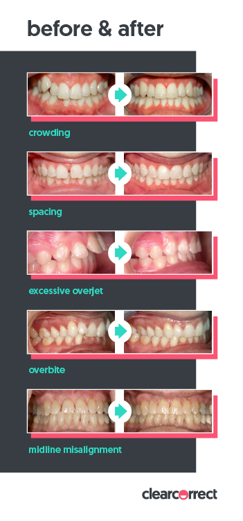 ClearCorrect_ALogoExample5